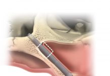 Zygoma Implantate für das Jochbein
