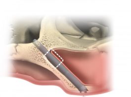 Zygoma Implantate für das Jochbein