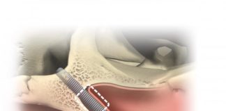 Zygoma Implantate für das Jochbein
