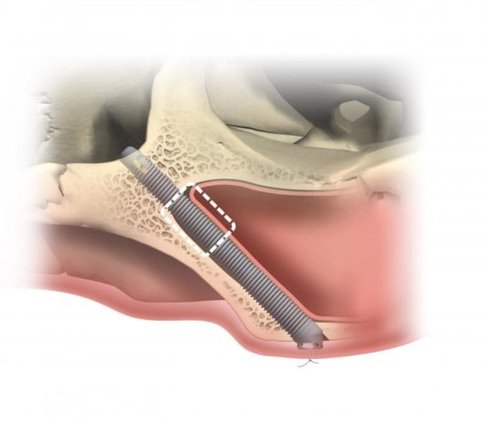Zygoma Implantate für das Jochbein