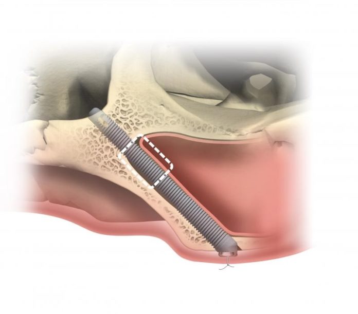 Zygoma Implantate für das Jochbein